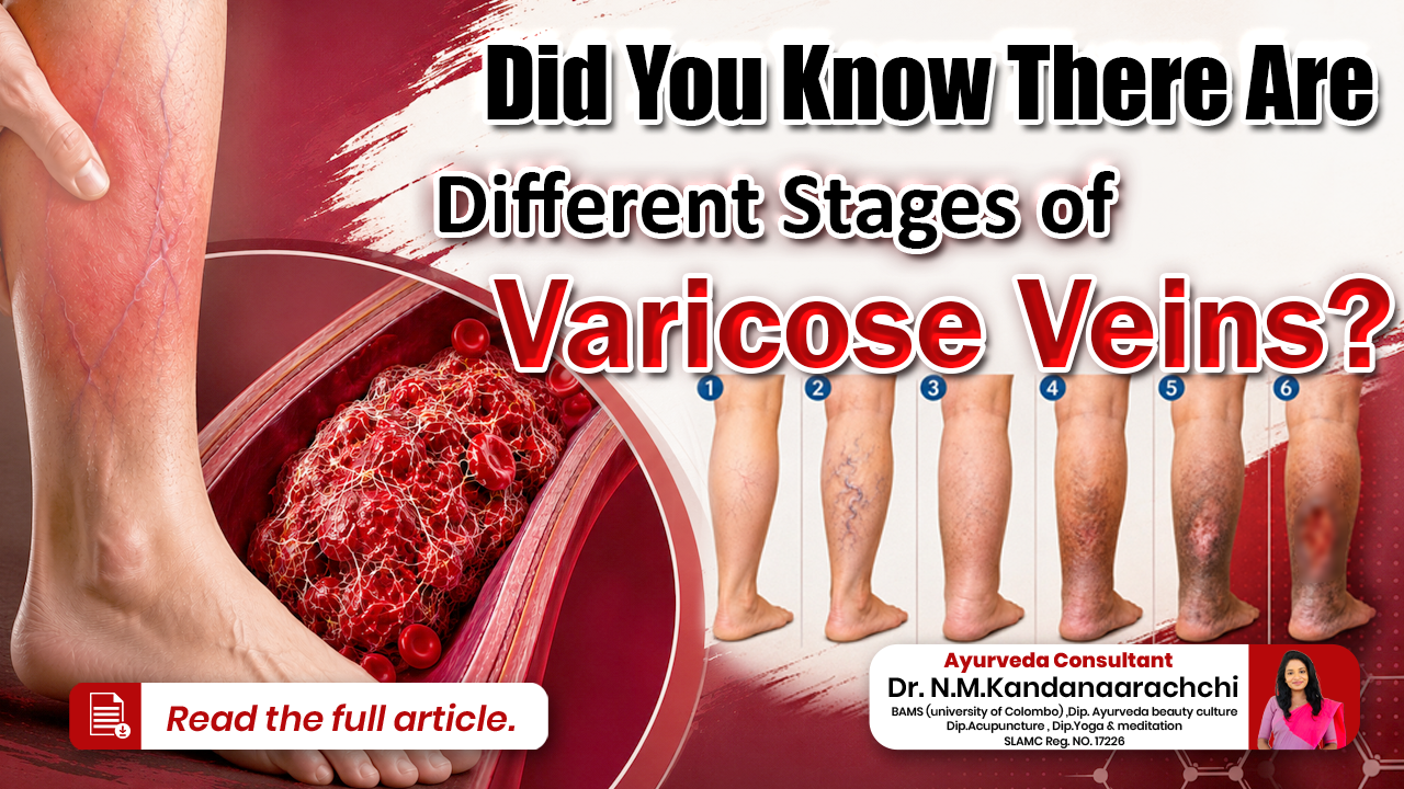 💡 Did you know there are different stages of varicose veins?